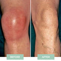 Nooro Knee Massager - Knee Pain Relief Device (gec)