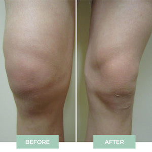 Nooro Knee Massager - Knee Pain Relief Device